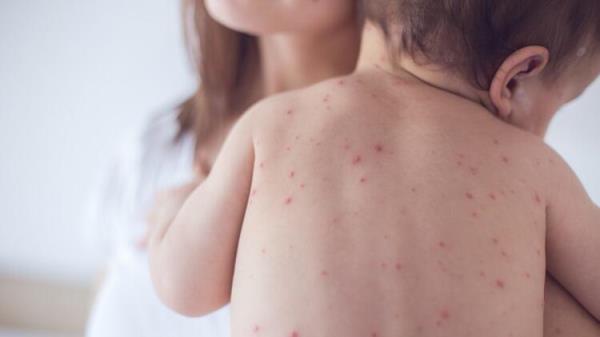 86 pct of measles cases in Istanbul: Koca