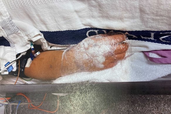 The alleged victim suffered significant burns.